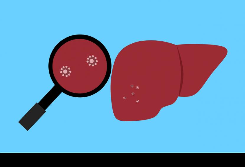 Ilustrasi Hepatitis. Wakil ketua DPD RI, Sultan B Najamudin, mendorong Kementerian Kesehatan RI untuk meningkatkan pengawasan dan deteksi dini terhadap hepatitis akut yang masih misterius penyebabnya dan sedang mengancam masyarakat, khususnya anak-anak di banyak negara saat ini.