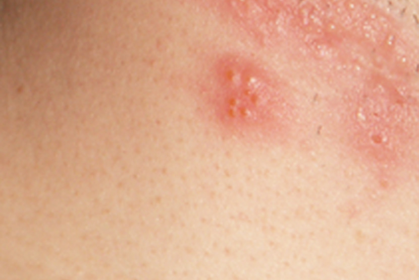 Cacar monyet adalah infeksi virus langka yang mirip dengan cacar pada manusia. Ilustrasi.